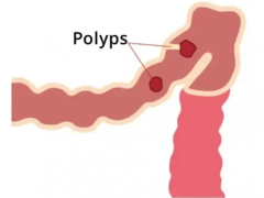 應(yīng)用 PDOS 對(duì)罕見(jiàn)病 FAP 和 MAP 患者進(jìn)行腫瘤防治